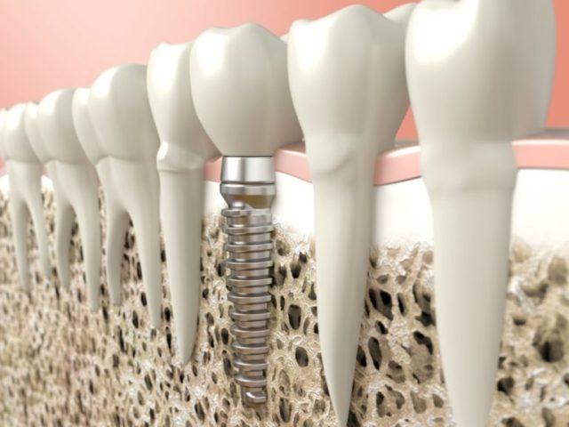 implantes-dentales-profilacticos-768x576