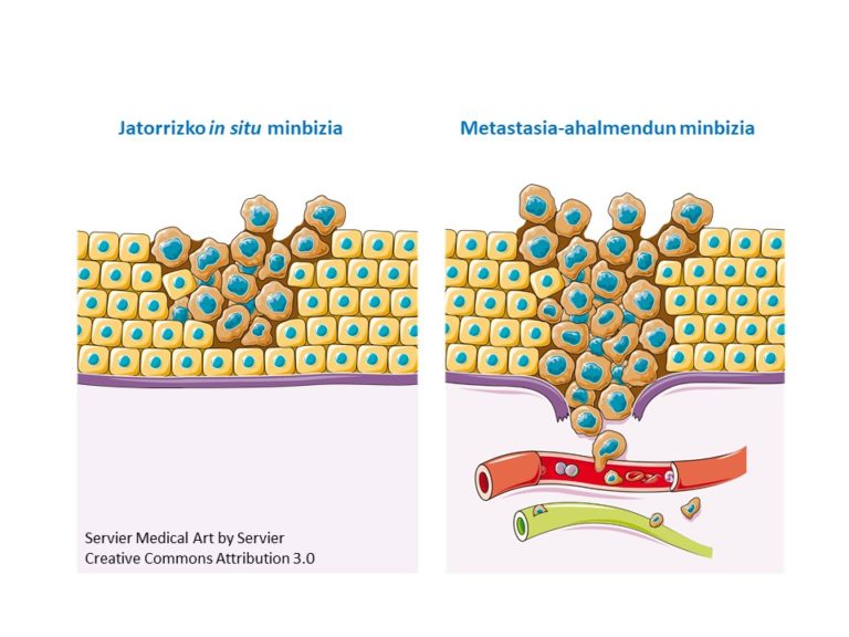 Zelulen portaera-aldaketa metastasiaren giltzarri