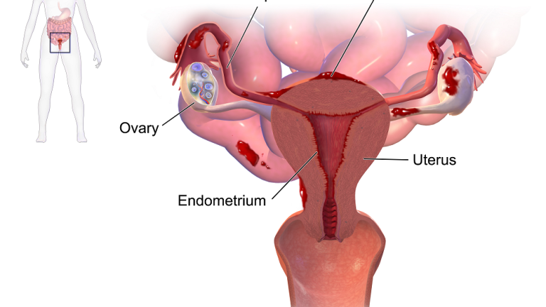 Endometriosia