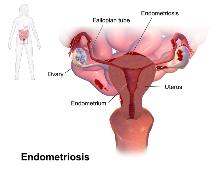 Endometriosia diagnostikatzeko oztopo lasterketa