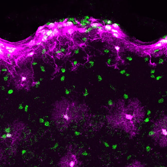 gaixotasun neurodegeneratibo